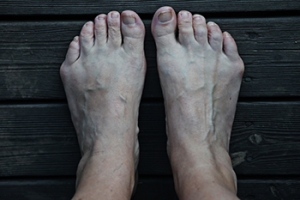 Minimally Invasive Bunionette Surgery