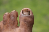 Types and Symptoms of Toenail Fungus
