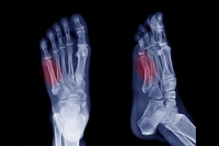 Types of Fifth Metatarsal Fractures