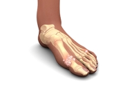 Understanding Gout and How to Manage It