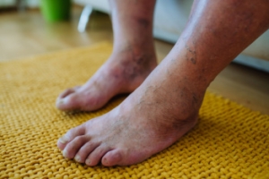 Protecting Your Feet From Serious Diabetic Complications