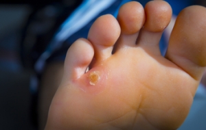 Causes and Symptoms of Foot Corns