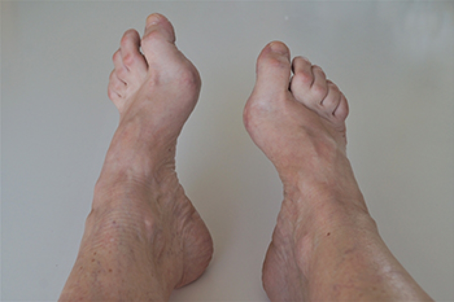 Foot Problems Linked to High Arches