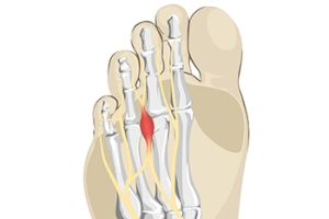 Key Facts About Morton&#039;s Neuroma